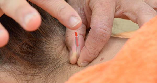 鍼灸施術